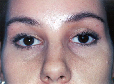 Brow Lift Before and After 03