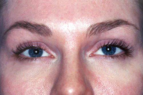 Brow Lift Before and After 04