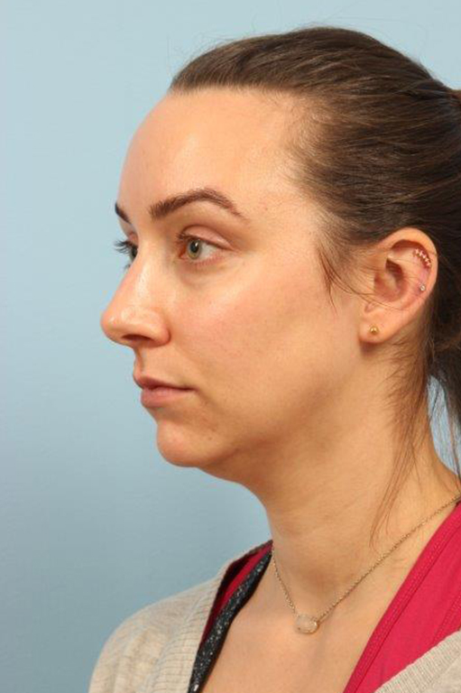 Chin Augmentation Before and After 01