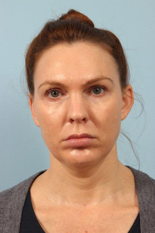 Chin Augmentation Before and After 02