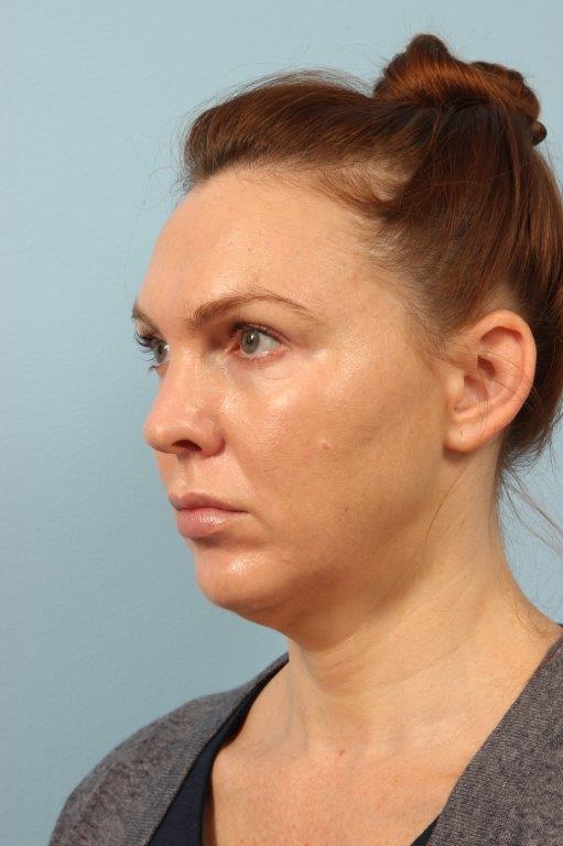 Chin Augmentation Before and After 02