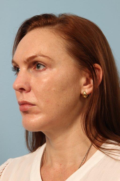 Chin Augmentation Before and After 02