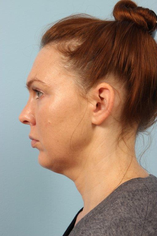 Chin Augmentation Before and After 02
