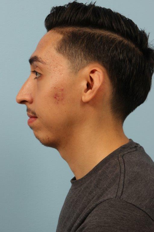 Chin Augmentation Before and After 03