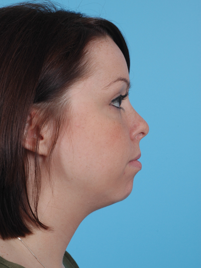 Chin Augmentation Before and After 05