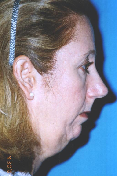 Chin Augmentation Before and After 10