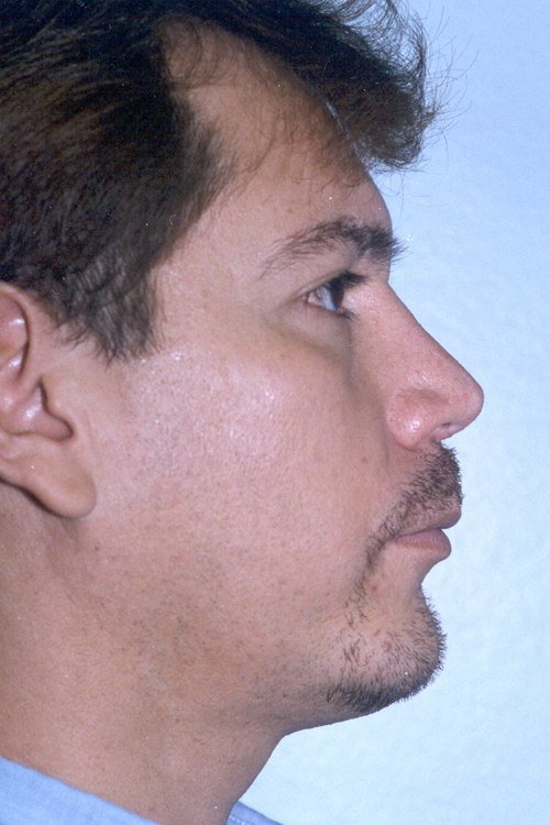 Chin Augmentation Before and After 08