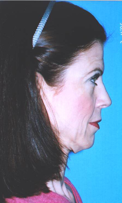 Facelift Before and After 01