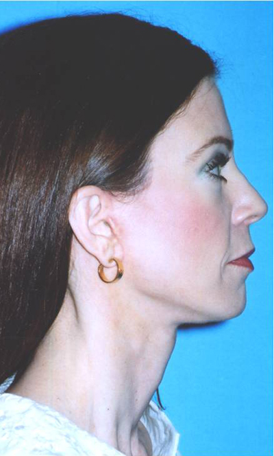 Facelift Before and After 01