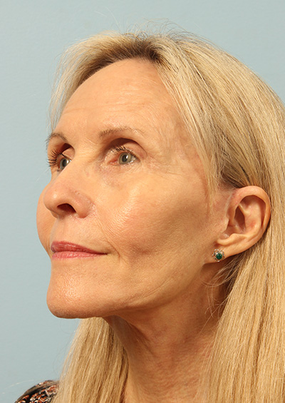 Facelift Before and After 03