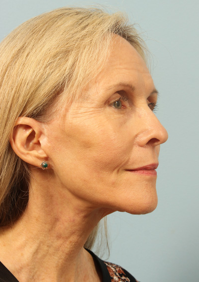 Facelift Before and After 03