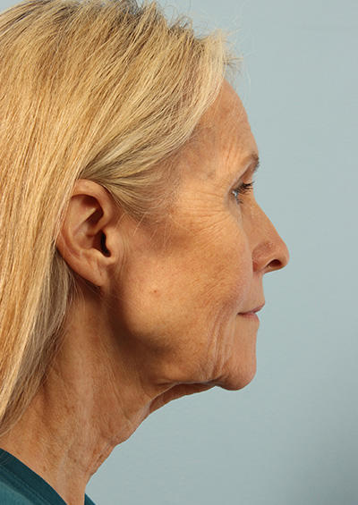 Facelift Before and After 03