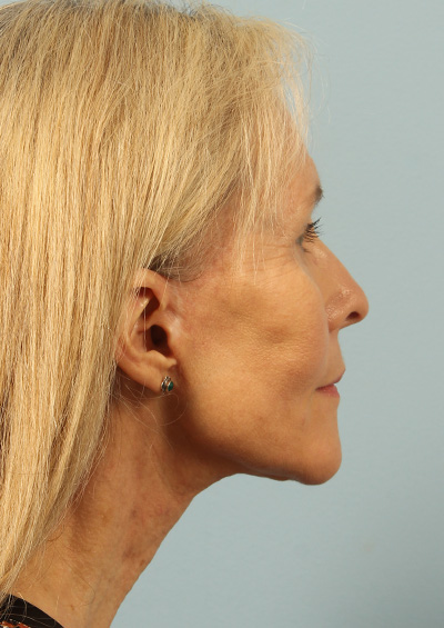 Facelift Before and After 03