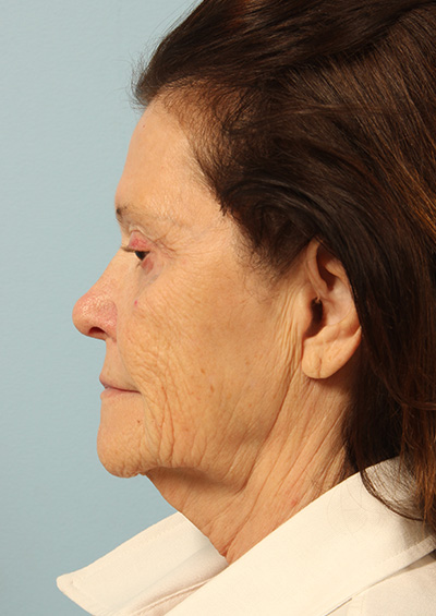 Facelift Before and After 04