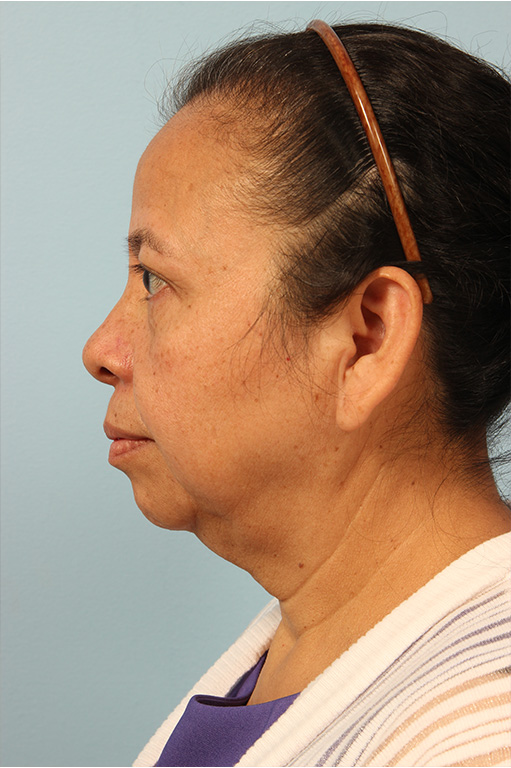 Facelift Before and After 06