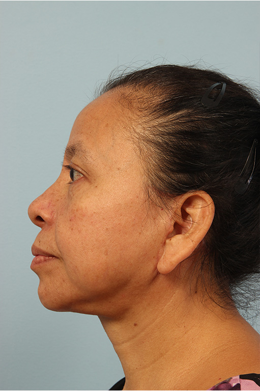 Facelift Before and After 06