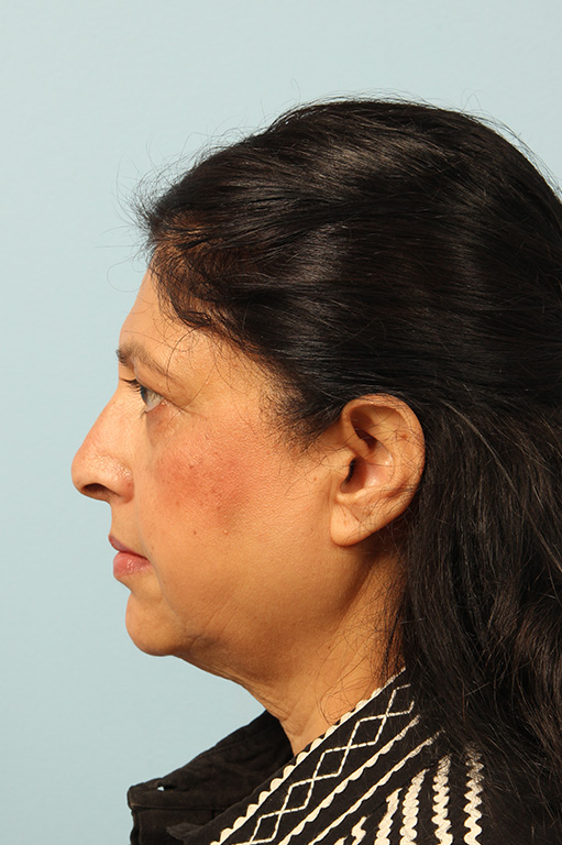 Facelift Before and After 07