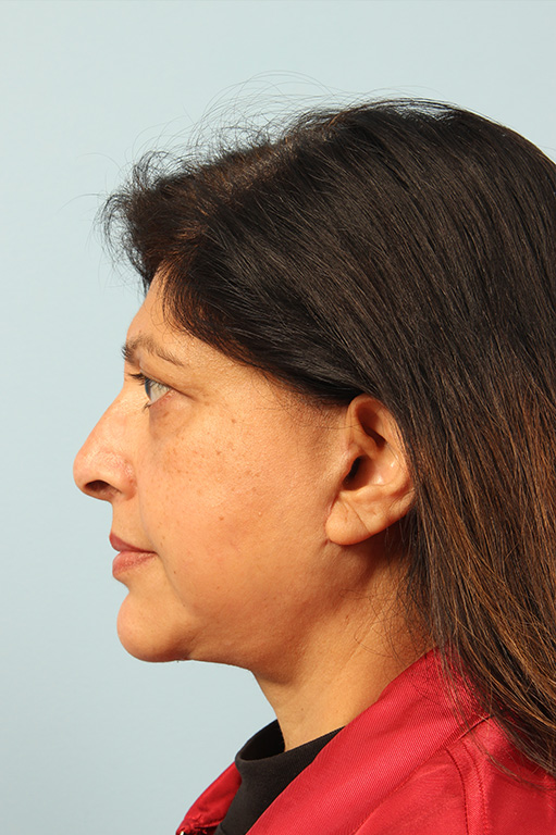 Facelift Before and After 07