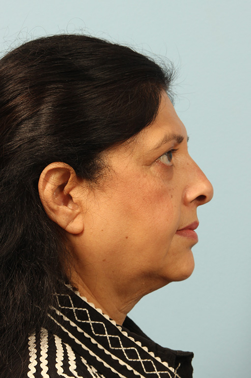 Facelift Before and After 07