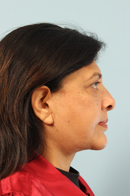 Facelift Before and After 07