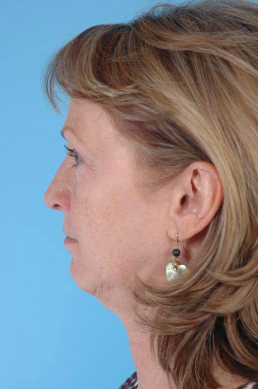 Facelift Before and After 13
