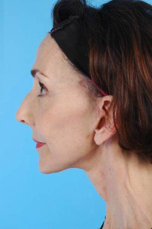 Facelift Before and After 15