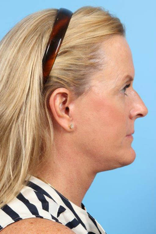 Facelift Before and After 21