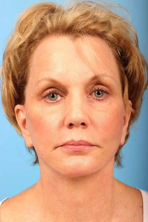 Facelift Before and After 27