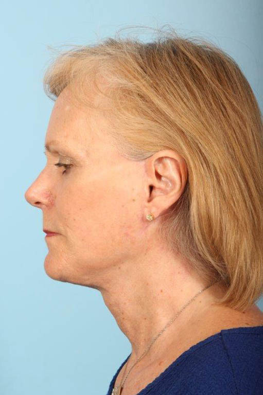 Facelift Before and After 25