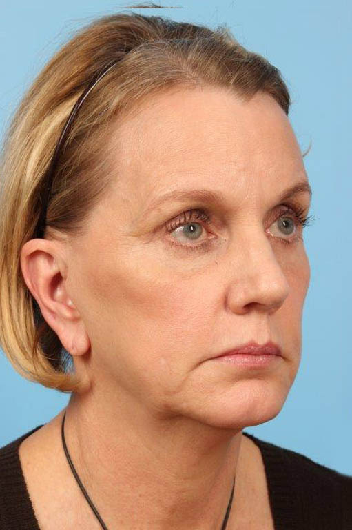 Facelift Before and After 27