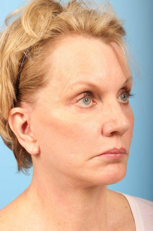 Facelift Before and After 27