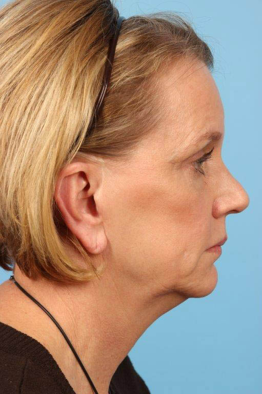 Facelift Before and After 27