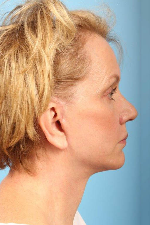 Facelift Before and After 27