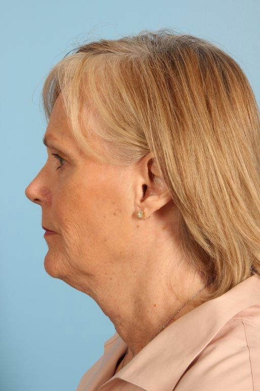 Facelift Before and After 28