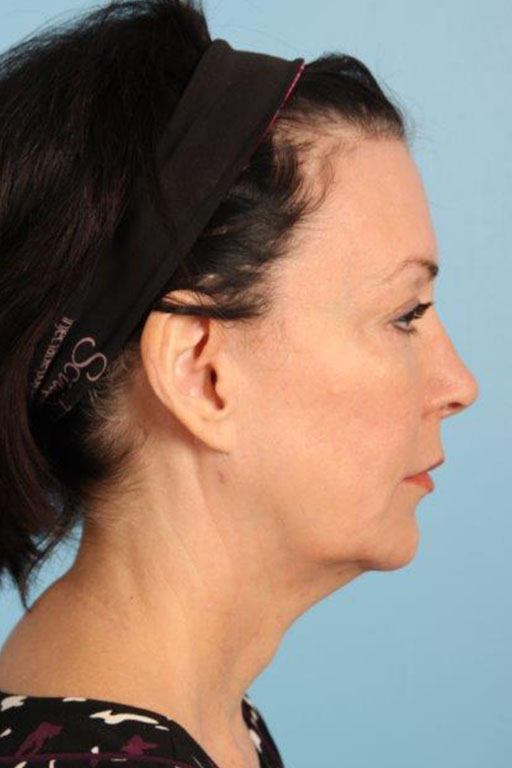 Facelift Before and After 29