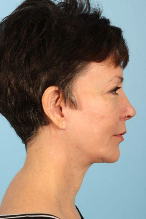 Facelift Before and After 29