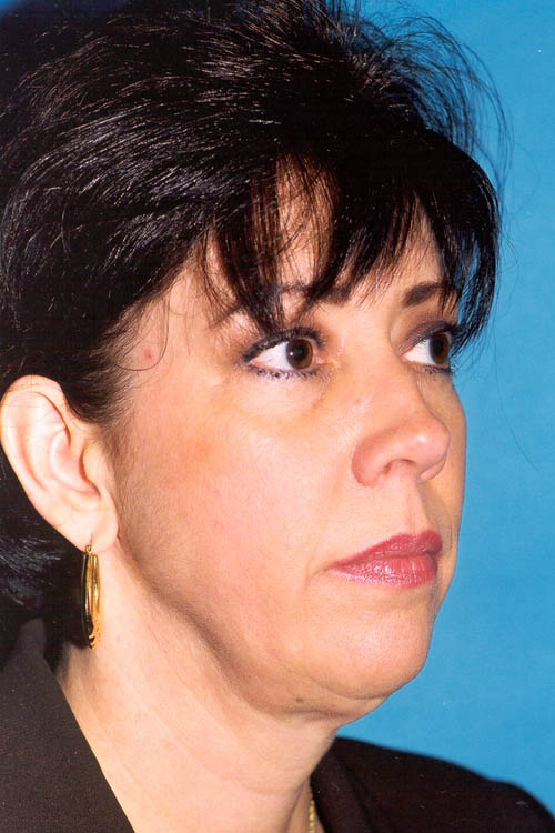 Facelift Before and After 31