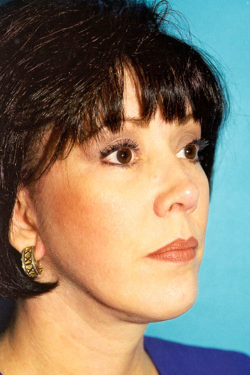 Facelift Before and After 31