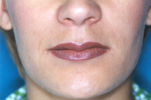 Lip Augmentation Before and After 01