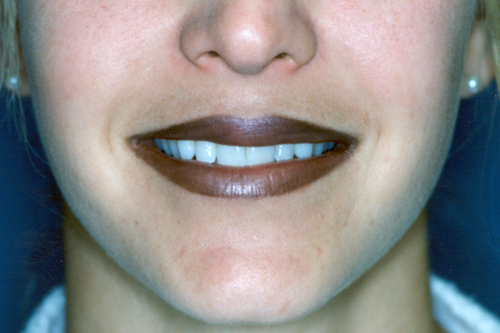 Lip Augmentation Before and After 02