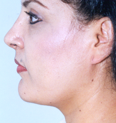 Neck Contouring Before and After 02