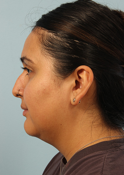 Neck Liposuction Before and After 01