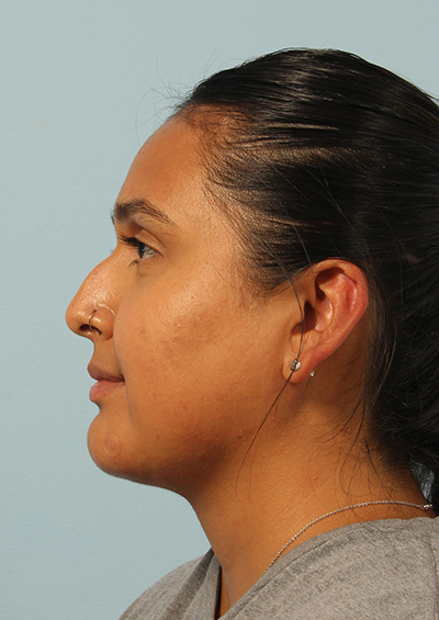 Neck Liposuction Before and After 01