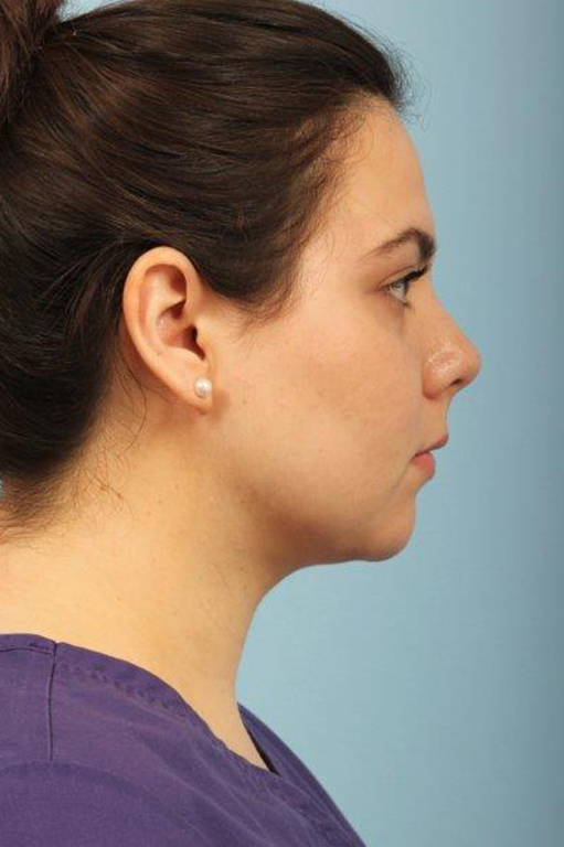 Neck Liposuction Before and After 02
