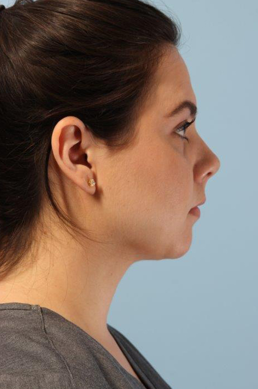 Neck Liposuction Before and After 02