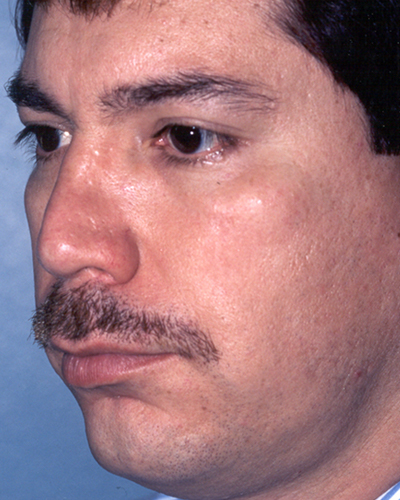 Neck Liposuction Before and After 08