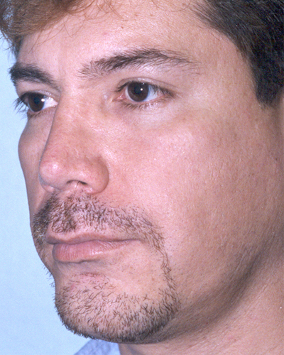 Neck Liposuction Before and After 08