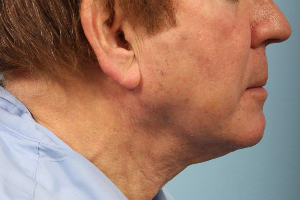 Neck Liposuction Before and After 10
