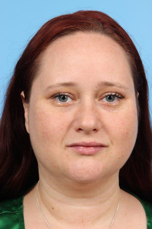 Neck Liposuction Before and After 11