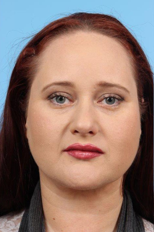 Neck Liposuction Before and After 01